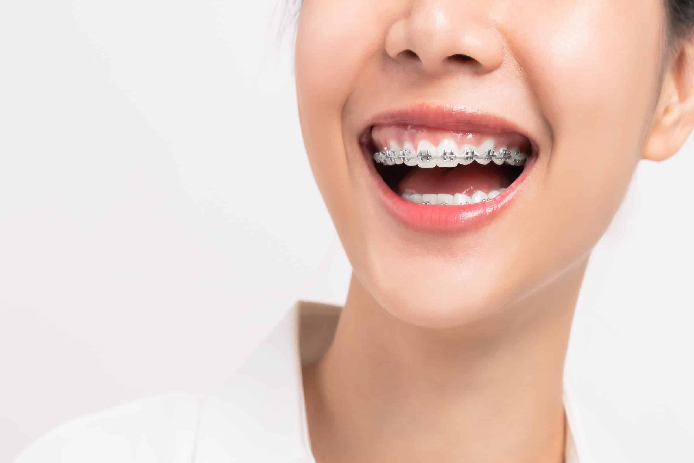 Damon Ultima Brackets Beitragsbild